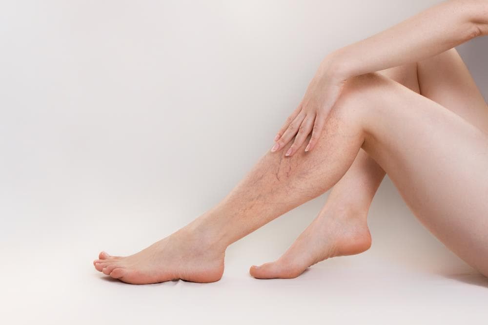 ¿En qué consiste el tratamiento de escleroterapia de varices con espuma?