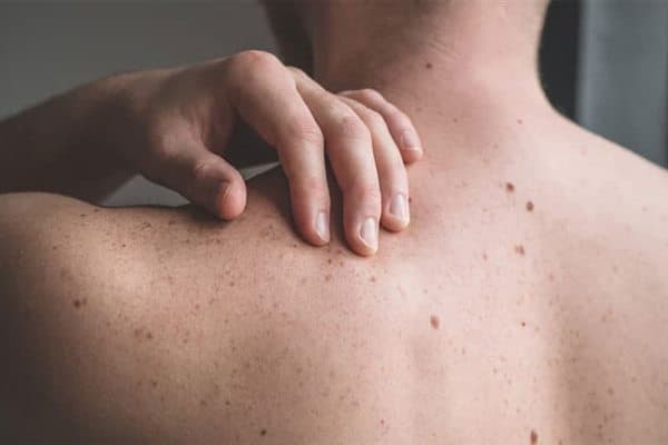 Tratamiento de pecas y lunares en Cangas