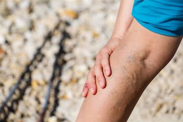 Tratamiento de varices y arañas vasculares en Cangas