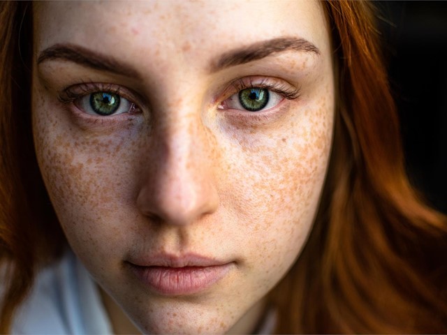 Tratamiento para eliminar las pecas y los lunares de la piel