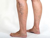 ¿Varices y arañas vasculares? Te enseñamos cómo cuidarlas