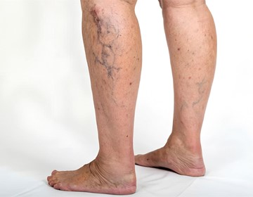 ¿Varices y arañas vasculares? Te enseñamos cómo cuidarlas