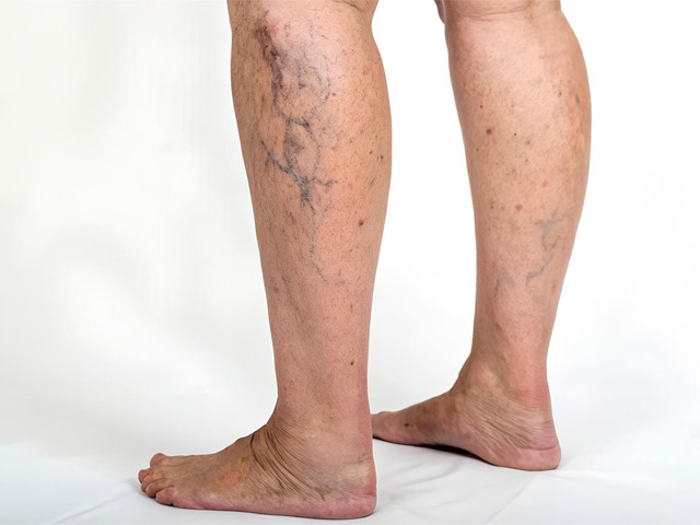 ¿Varices y arañas vasculares? Te enseñamos cómo cuidarlas